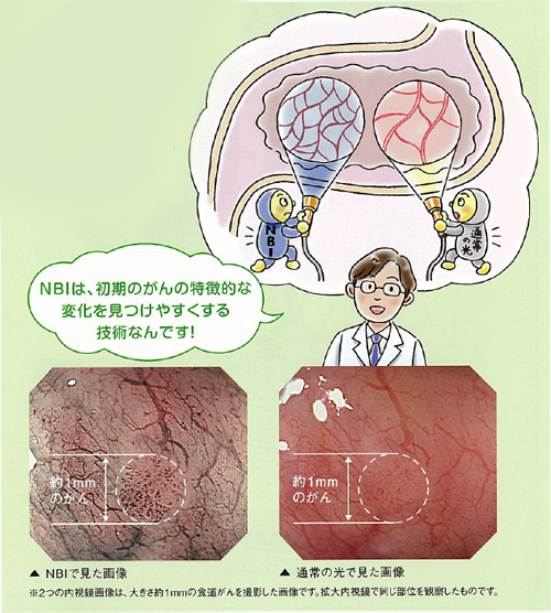 なぜNBIは早期発見につながりやすいの？