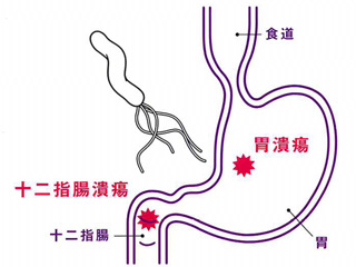 ヘリコバクター・ピロリ菌って何ですか？